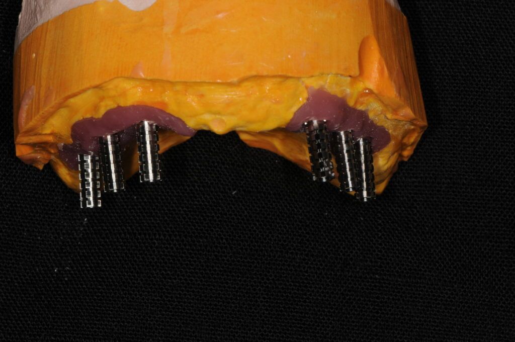Straight vs Angled Dental Implant Placement? New Smile Prosthodontics